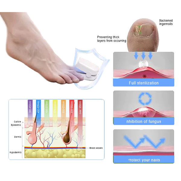 Oveallgo™ PROMAX Revolutionary High-Efficiency Light Therapy Device For Toenail Diseases