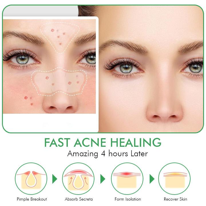 Oveallgo™ Overnight Hydrocolloid Acne Clear Patches